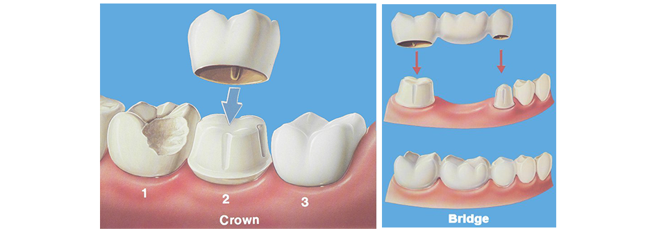 Crowns & Bridges Port Hope - Avery Dental